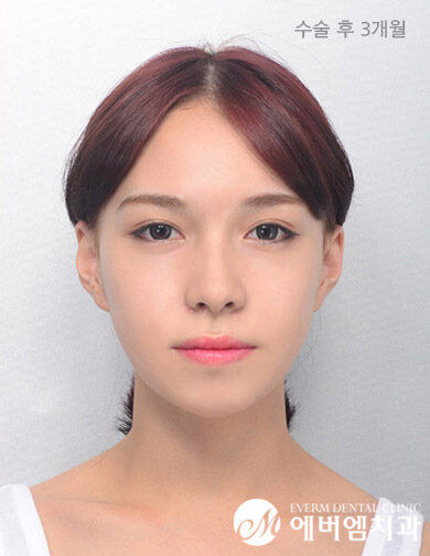 หลังผ่าตัด V-Line Double Jaw Surgery