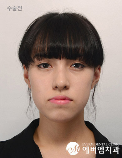 ก่อนผ่าตัด V-Line Double Jaw Surgery