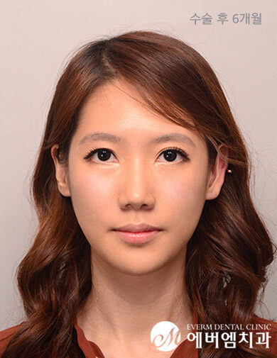 หลังผ่าตัด V-Line Double Jaw Surgery