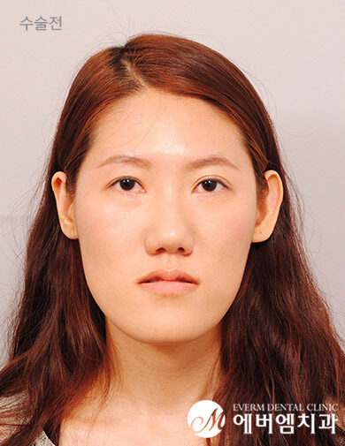 ก่อนผ่าตัด V-Line Double Jaw Surgery