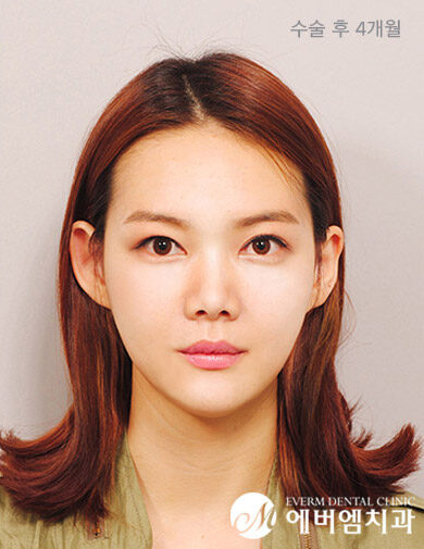 หลังผ่าตัด V-Line Double Jaw Surgery