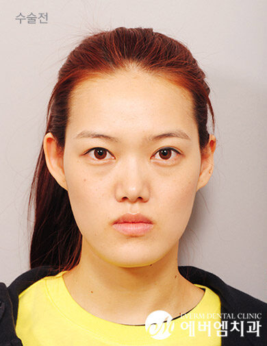 ก่อนผ่าตัด V-Line Double Jaw Surgery