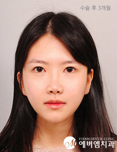 หลังผ่าตัด V-Line Double Jaw Surgery