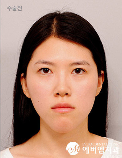 ก่อนผ่าตัด V-Line Double Jaw Surgery