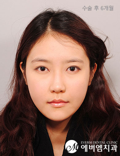 หลังผ่าตัด V-Line Double Jaw Surgery
