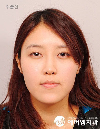ก่อนผ่าตัด V-Line Double Jaw Surgery