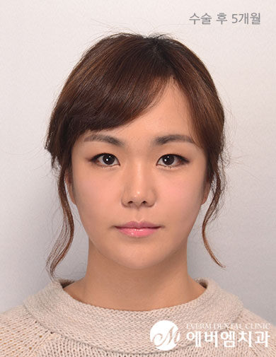 หลังผ่าตัด V-Line Double Jaw Surgery