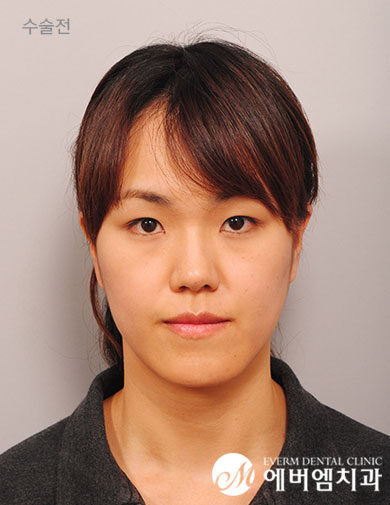 ก่อนผ่าตัด V-Line Double Jaw Surgery
