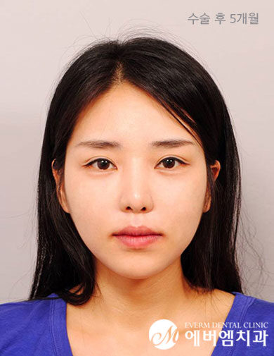 หลังผ่าตัด V-Line Double Jaw Surgery
