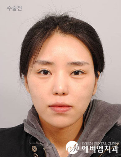 ก่อนผ่าตัด V-Line Double Jaw Surgery