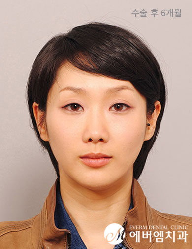 หลังผ่าตัด V-Line Double Jaw Surgery