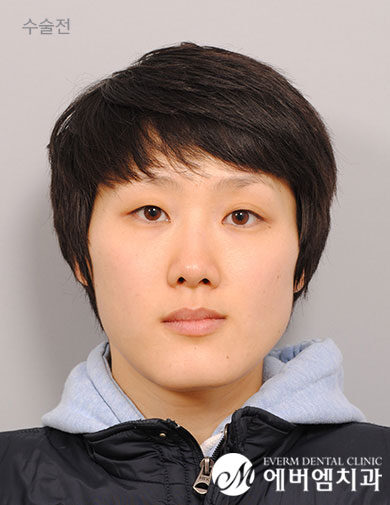 ก่อนผ่าตัด V-Line Double Jaw Surgery