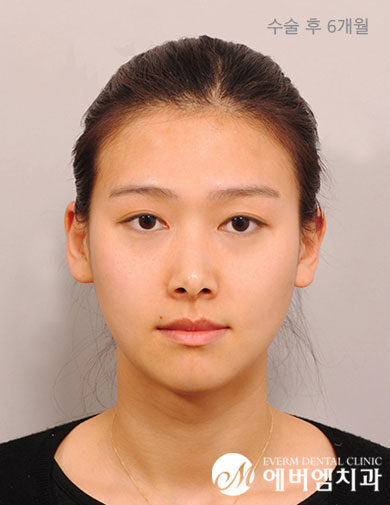 หลังผ่าตัด V-Line Double Jaw Surgery