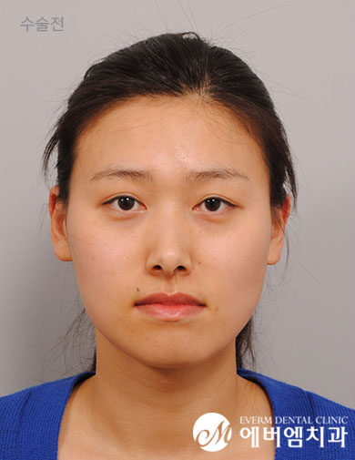 ก่อนผ่าตัด V-Line Double Jaw Surgery