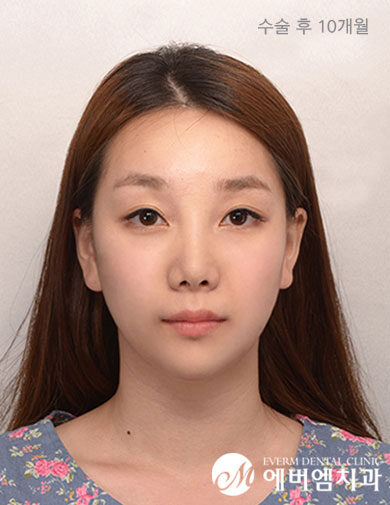 หลังผ่าตัด V-Line Double Jaw Surgery