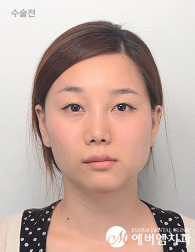 ก่อนผ่าตัด V-Line Double Jaw Surgery
