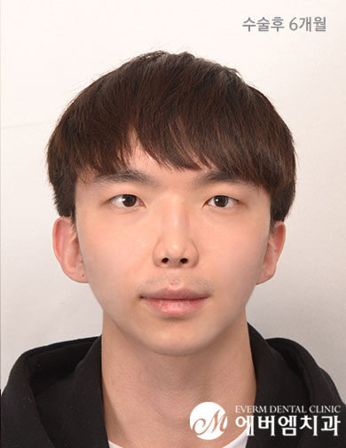 หลังผ่าตัด V-Line Double Jaw Surgery