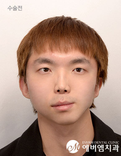 ก่อนผ่าตัด V-Line Double Jaw Surgery
