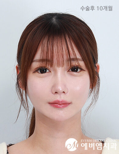 หลังผ่าตัด Maxillary + Chin + Cheekbone Reduction (Revision)