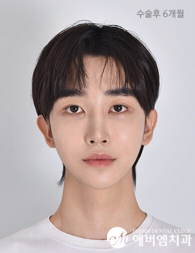 หลังผ่าตัด V-Line Surgery