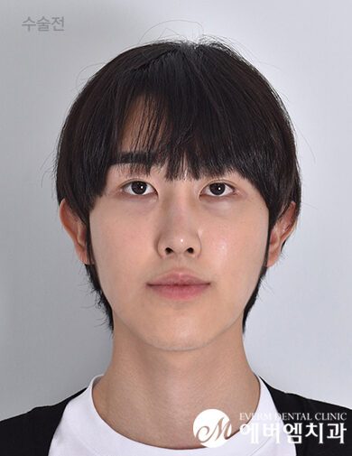 ก่อนผ่าตัด V-Line Surgery