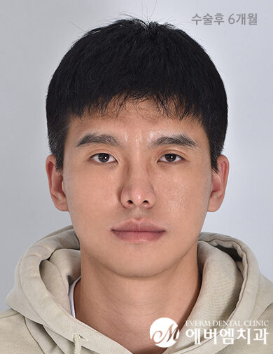 หลังผ่าตัด Mandible Surgery