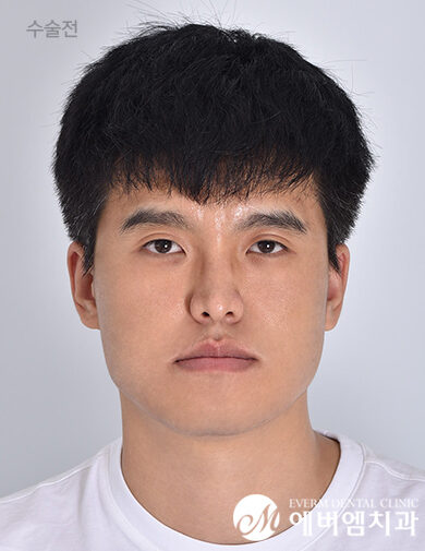 ก่อนผ่าตัด Mandible Surgery