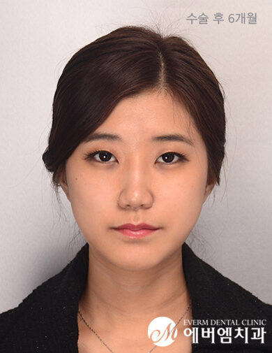 หลังผ่าตัด Long Face + Underbite + Square Jaw Surgery