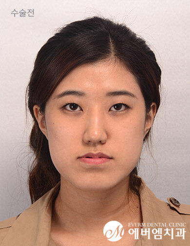 ก่อนผ่าตัด Long Face + Underbite + Square Jaw Surgery