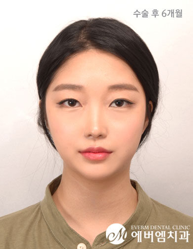 หลังผ่าตัด Mandible Contouring Surgery