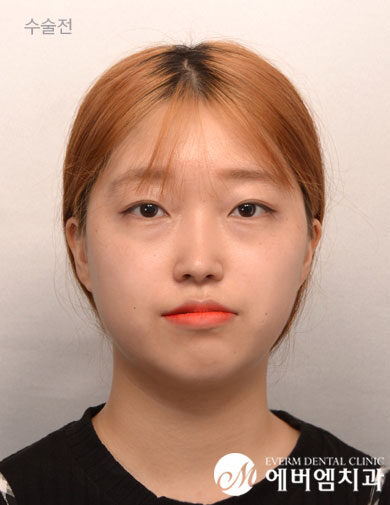 ก่อนผ่าตัด Mandible Contouring Surgery