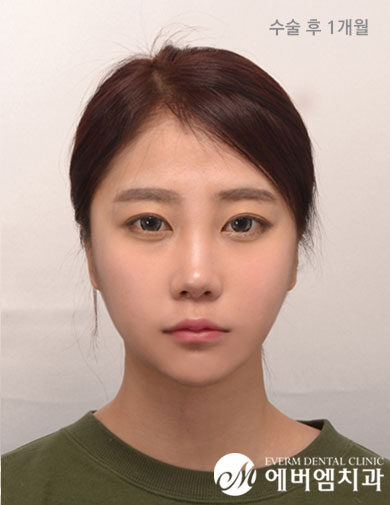 หลังผ่าตัด V-Line + Cheekbone Surgery