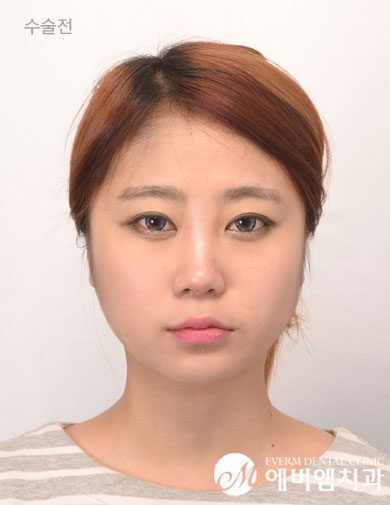 ก่อนผ่าตัด V-Line + Cheekbone Surgery