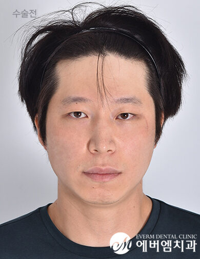 ก่อนผ่าตัด Protruding Mouth + Chin Surgery