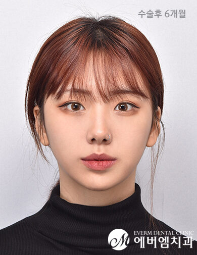 หลังผ่าตัด Protruding Mouth + 3-Part Contouring Surgery