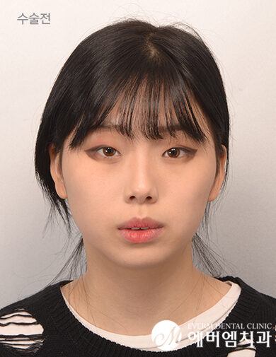ก่อนผ่าตัด Protruding Mouth + 3-Part Contouring Surgery