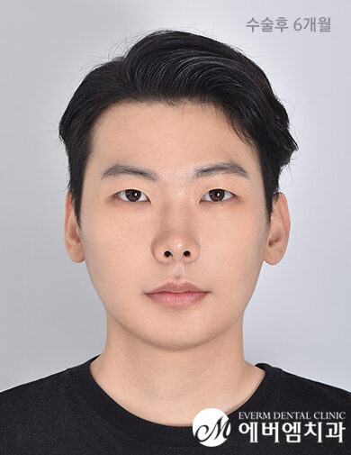 หลังผ่าตัด Protruding Mouth + Maxillary + Chin Surgery