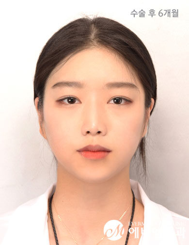 หลังผ่าตัด Protruding Mouth + Contouring Surgery