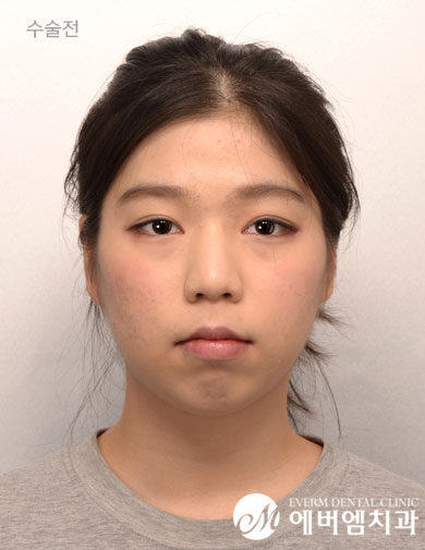 ก่อนผ่าตัด Protruding Mouth + Contouring Surgery