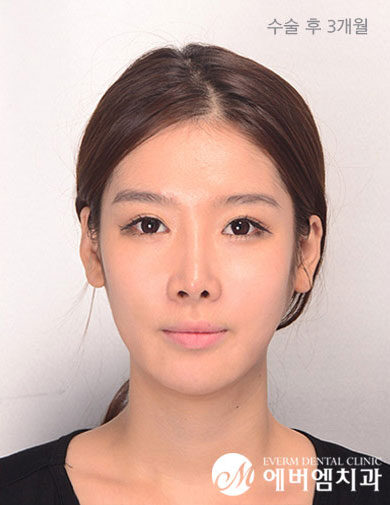 หลังผ่าตัด Protruding Mouth Surgery
