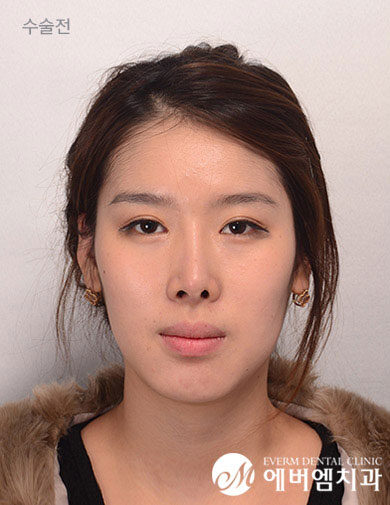 ก่อนผ่าตัด Protruding Mouth Surgery