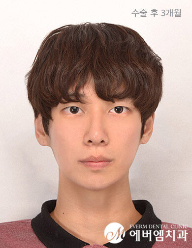 หลังผ่าตัด Protruding Mouth Double Jaw Surgery