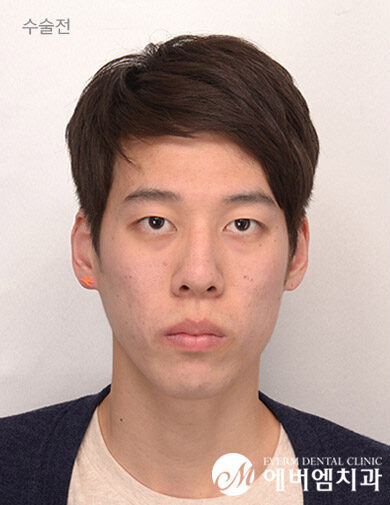 ก่อนผ่าตัด Protruding Mouth Double Jaw Surgery