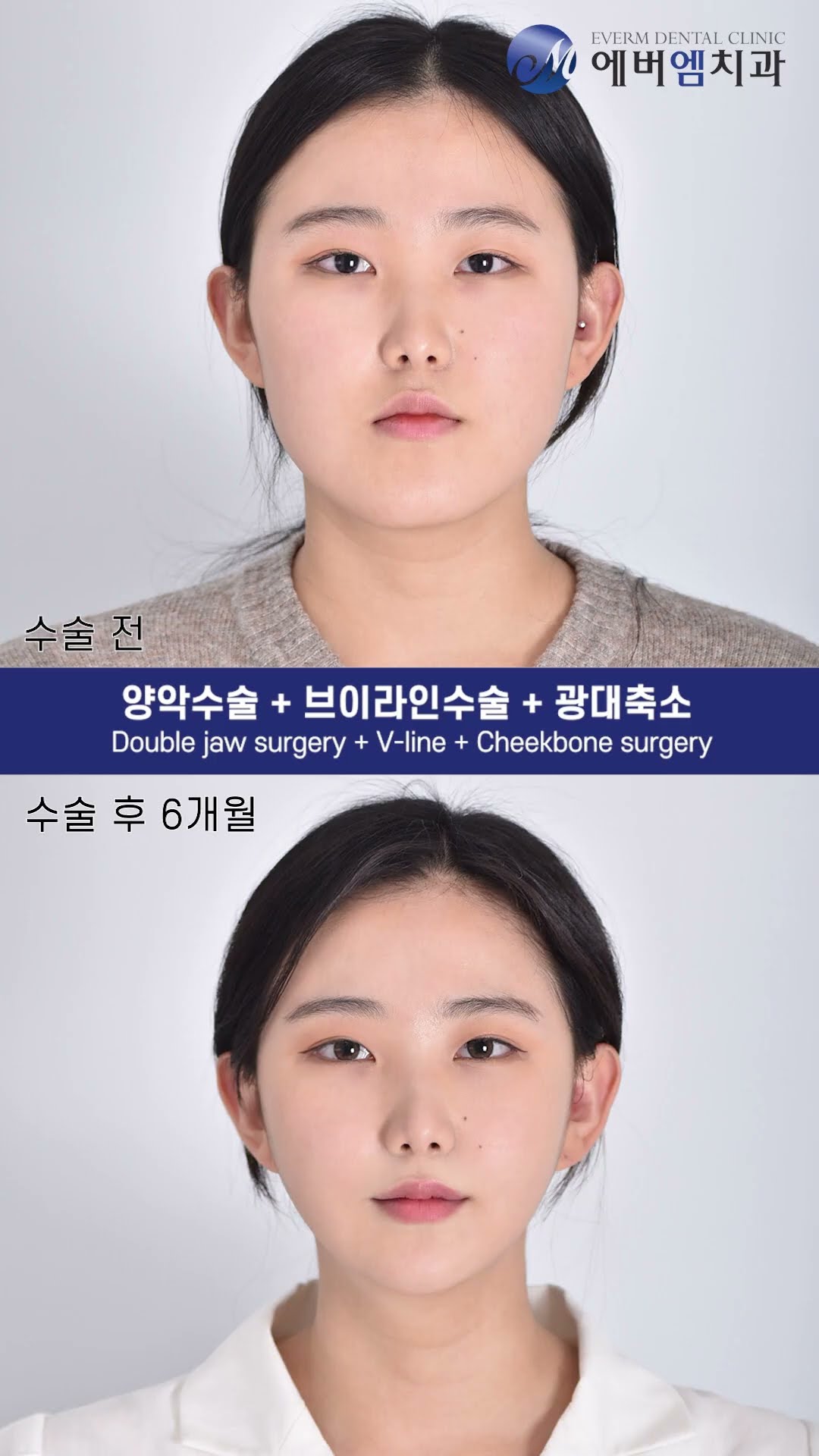 รีวิววิดีโอ ผ่าตัดขากรรไกร + V-line + ลดโหนกแก้ม
