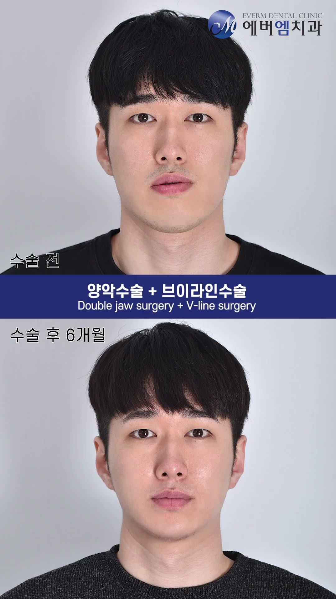 รีวิววิดีโอ ผ่าตัดขากรรไกร EVERM