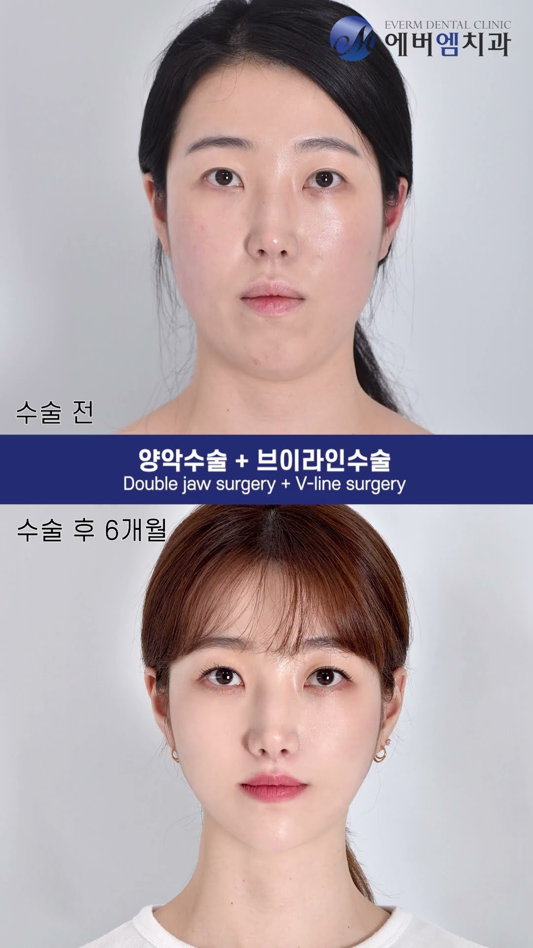 รีวิววิดีโอ ผ่าตัดขากรรไกร EVERM